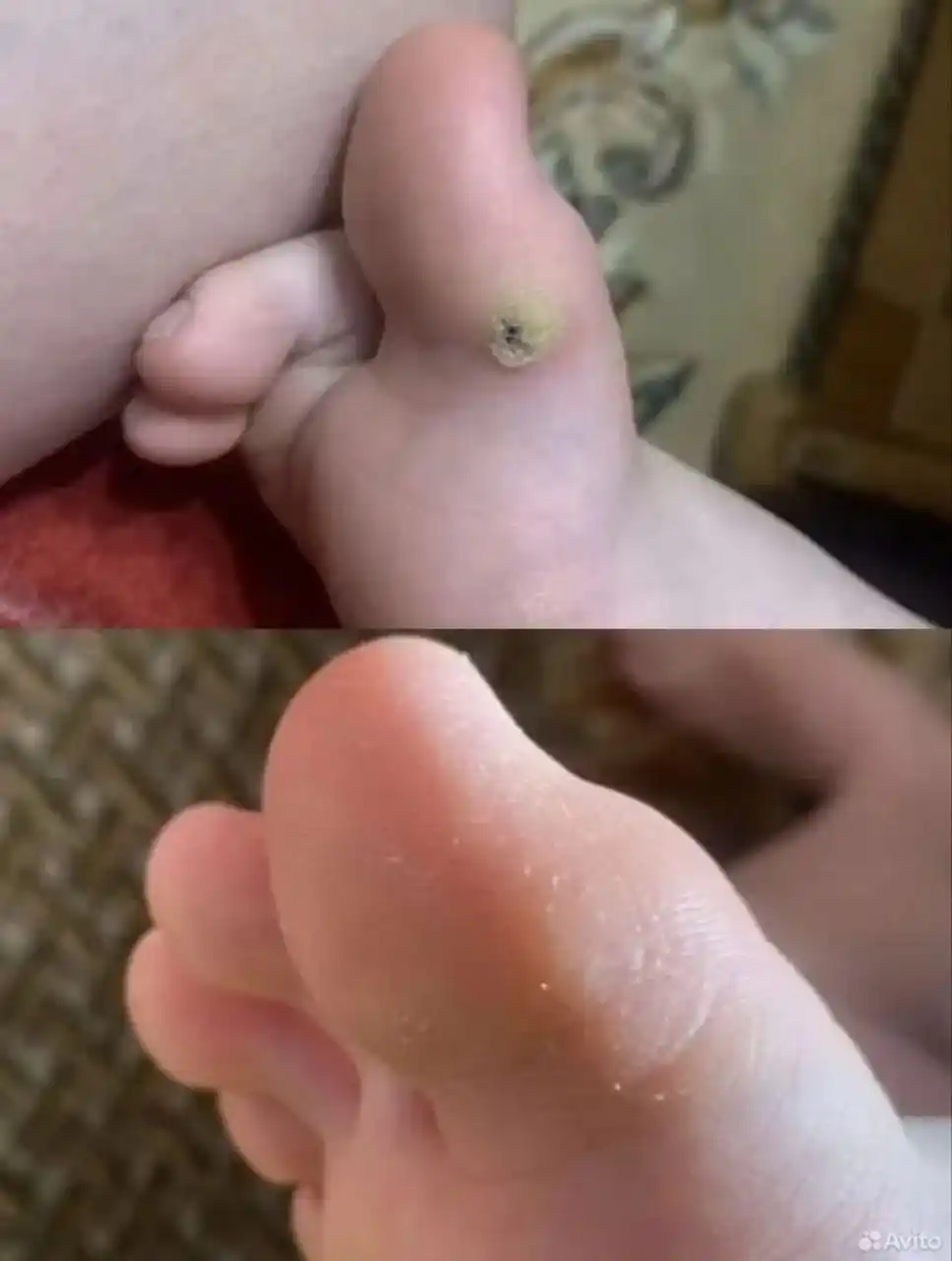 Мазь от грибка ногтя, шипиц и папилом