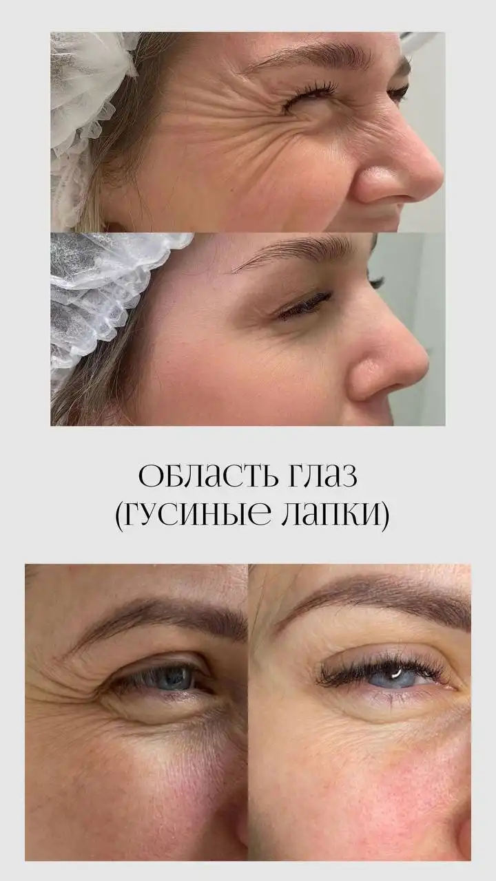 Модели на ботокс в Саратове - Красота и здоровье (Услуги) в Саратов