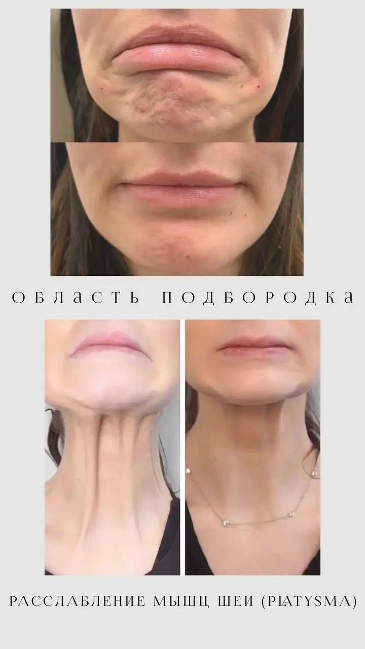 Модели на ботокс в Саратове - Красота и здоровье (Услуги) в Саратов