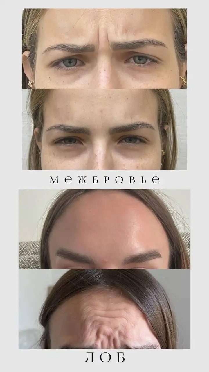 Модели на ботокс в Саратове - Красота и здоровье (Услуги) в Саратов