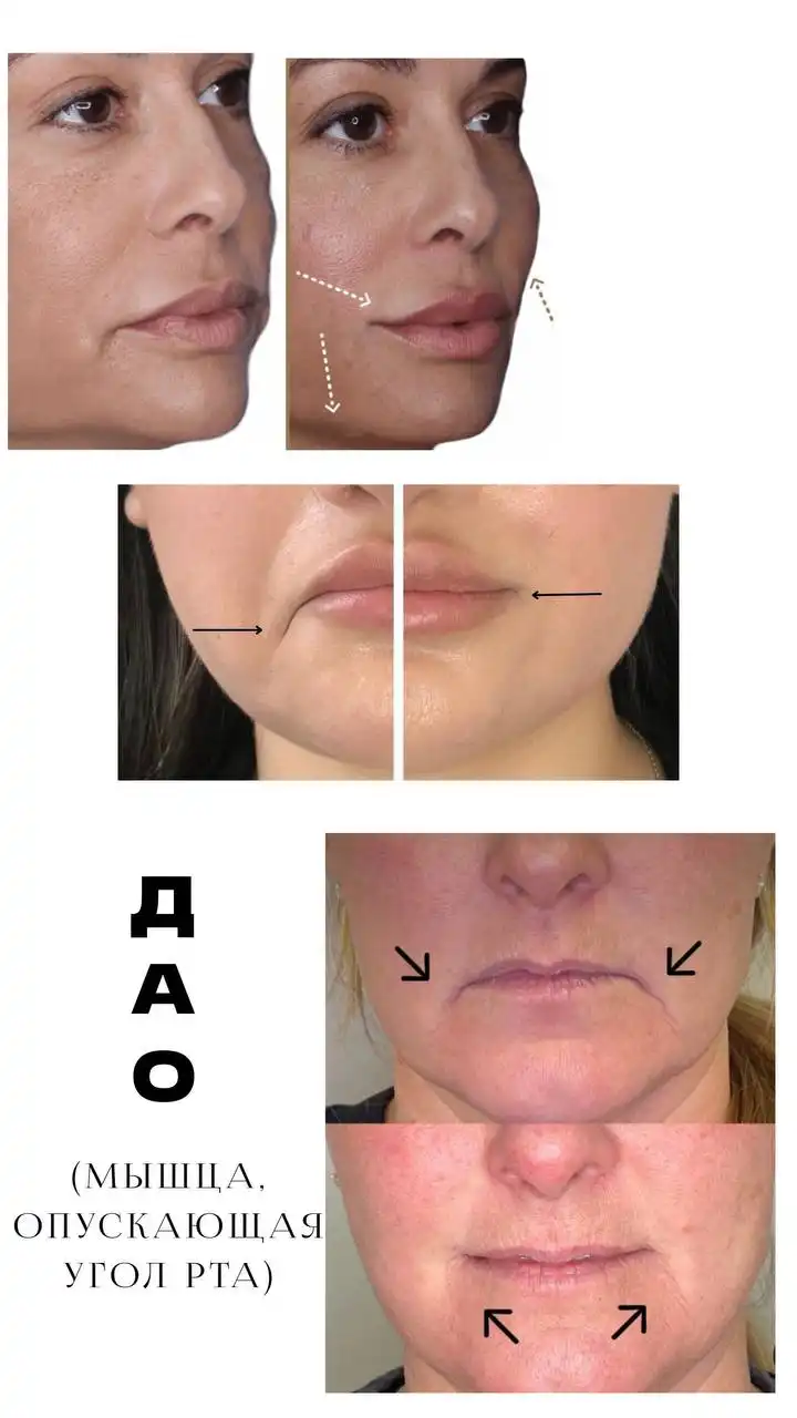 Модели на ботокс в Саратове - Красота и здоровье (Услуги) в Саратов