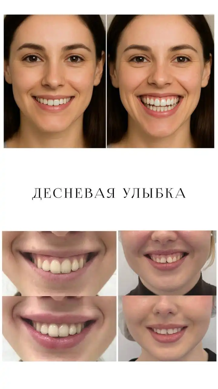 Модели на ботокс в Саратове - Красота и здоровье (Услуги) в Саратов