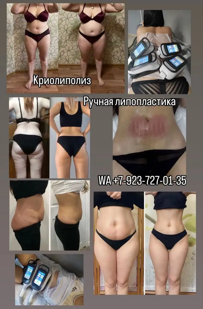 Ручная липопластика и Криолиполиз