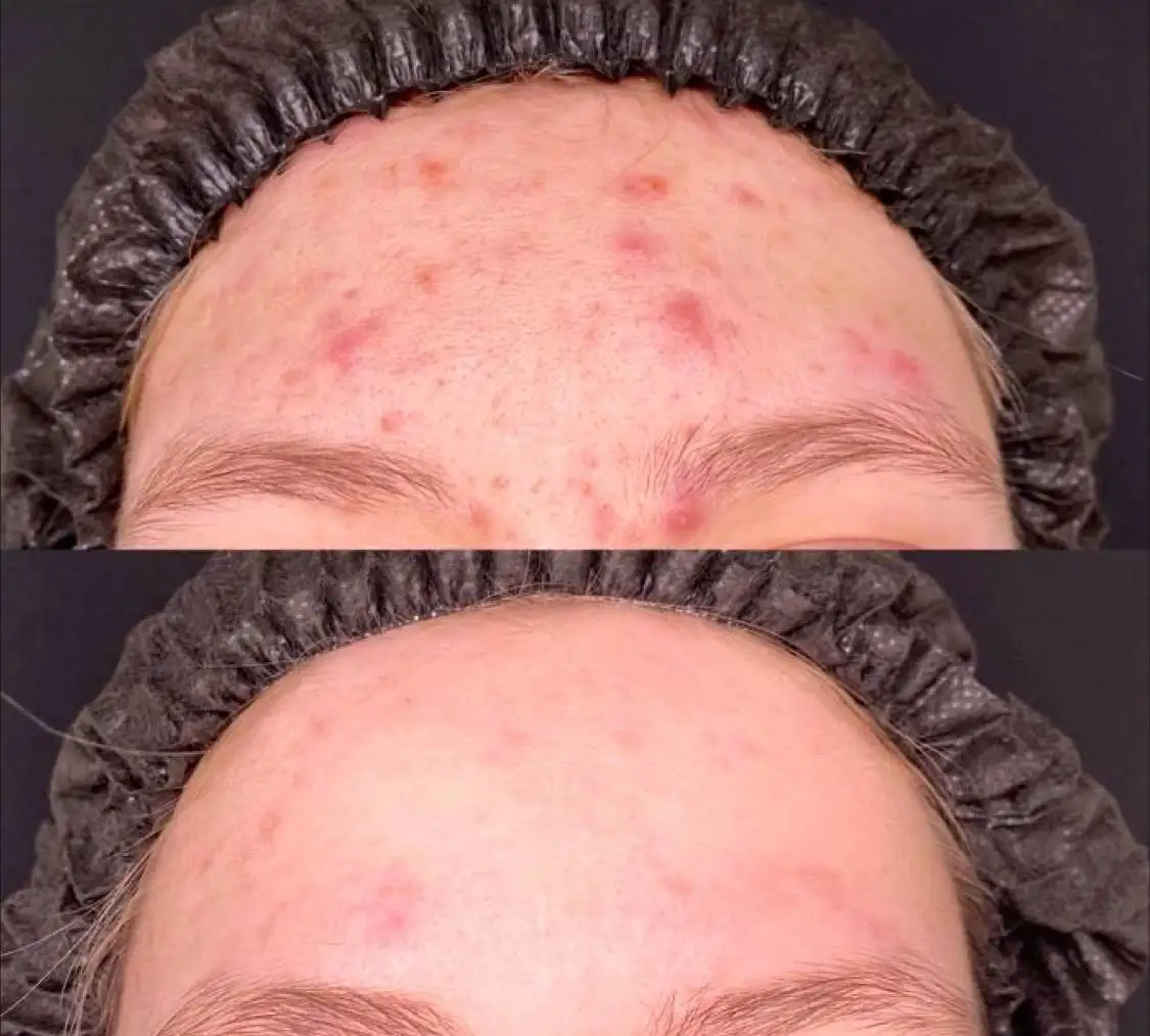 Лечение акне: долгосрочная программа - Косметология (Услуги) в Чебоксары