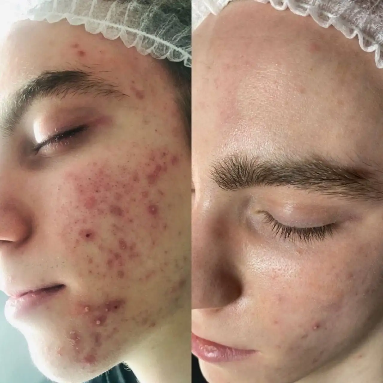 Лечение акне: долгосрочная программа - Косметология (Услуги) в Чебоксары