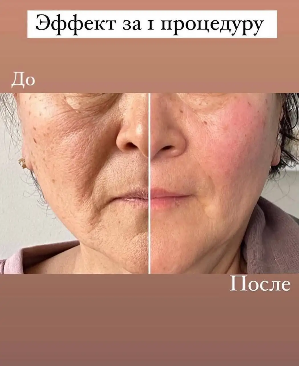 Массаж лица для лифтинга без уколов - Косметические услуги (Услуги) в Чебоксары