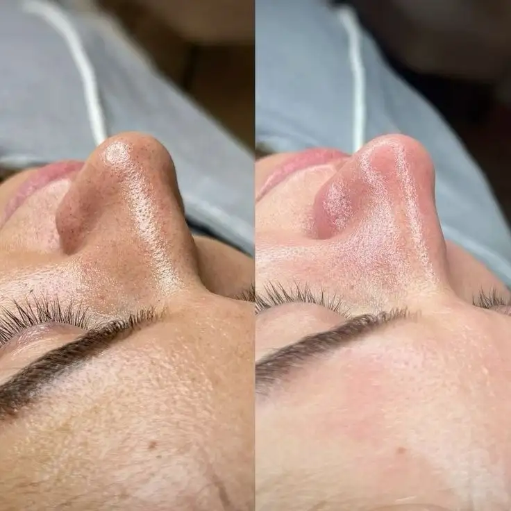 Комплексная чистка кожи 9 шагов от GIGI - Услуги косметолога (Красота и здоровье) в Чебоксары