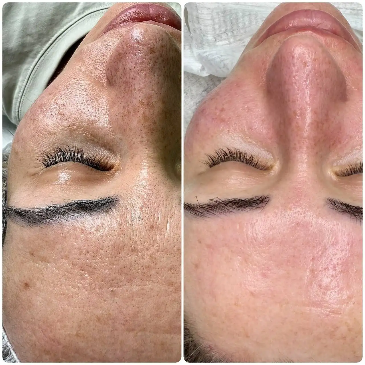 Всесезонный пилинг и комплекс чистка+пилинг - Косметологические услуги (Красота и здоровье) в Чебоксары