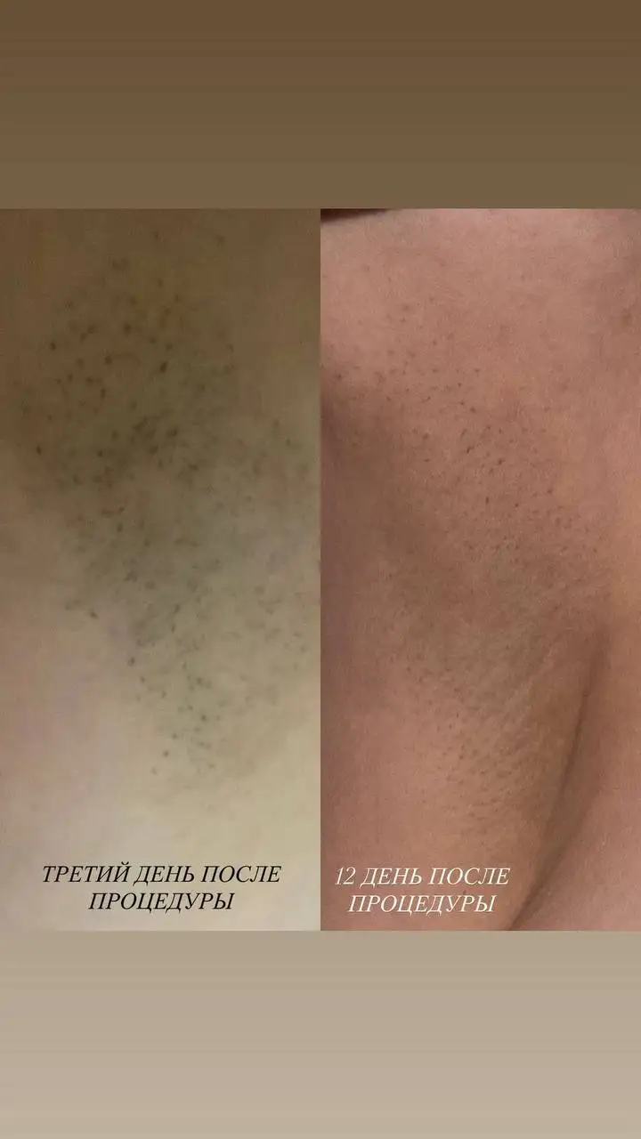 Лазерная эпиляция Дзен Лазер в Краснодаре - Косметология (Услуги) в Краснодар