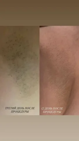 Лазерная эпиляция Дзен Лазер в Краснодаре - Производство мебели в Краснодар