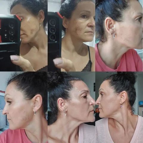 Услуги по коррекции пигментации и выравниванию тона кожи - Медицинские изделия в Краснодар