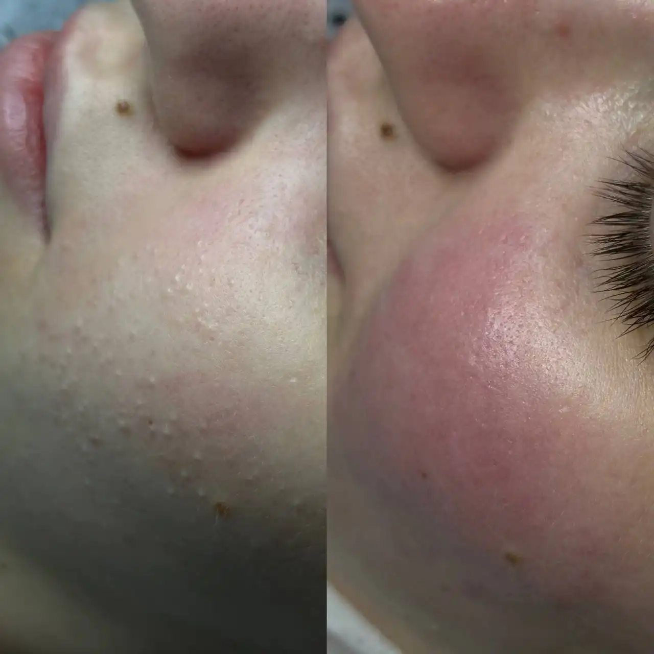 Комбинированная чистка лица со скидкой - Косметология (Красота и здоровье) в Красноярск