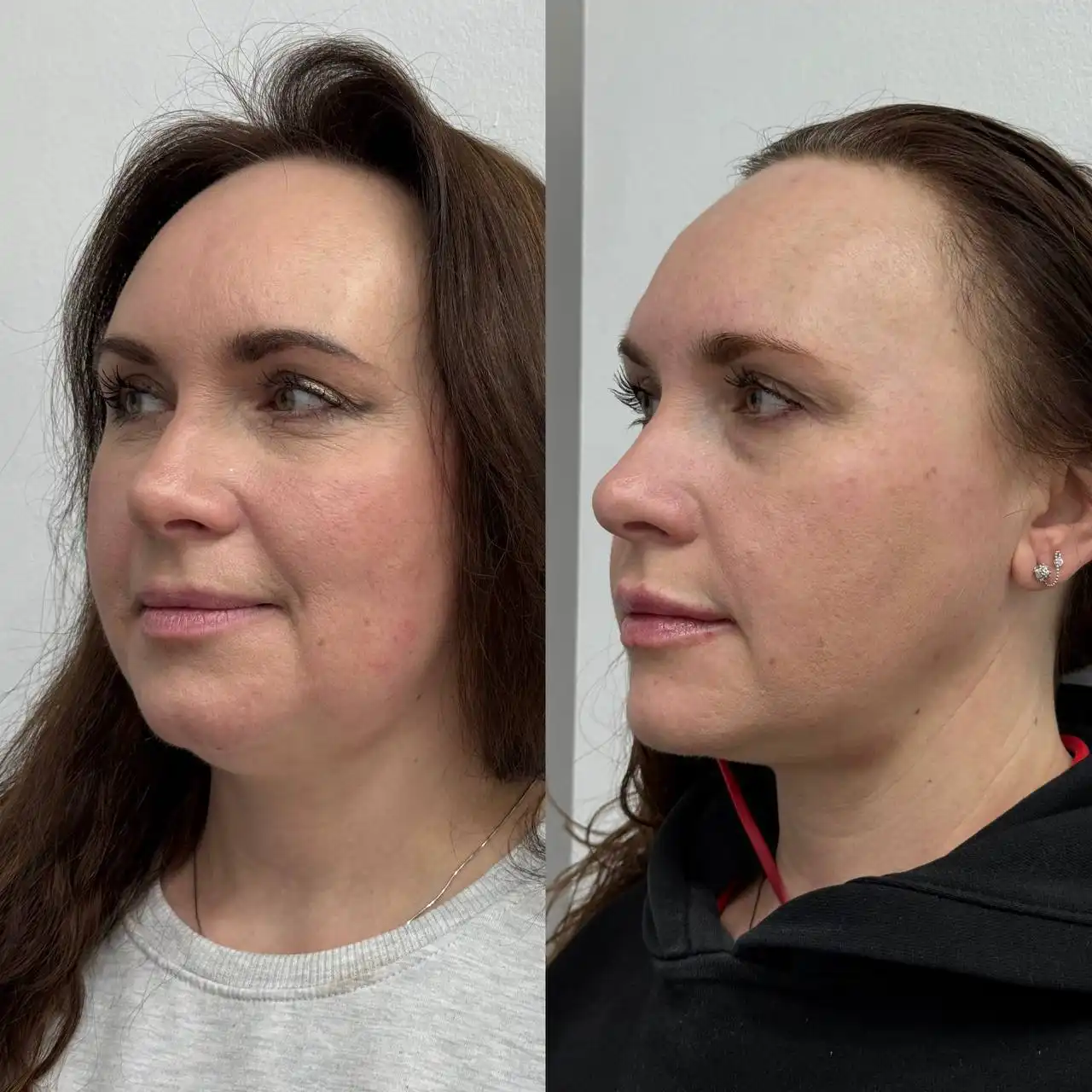 Акции февраля на косметологические процедуры - Косметология (Красота и здоровье) в Красноярск