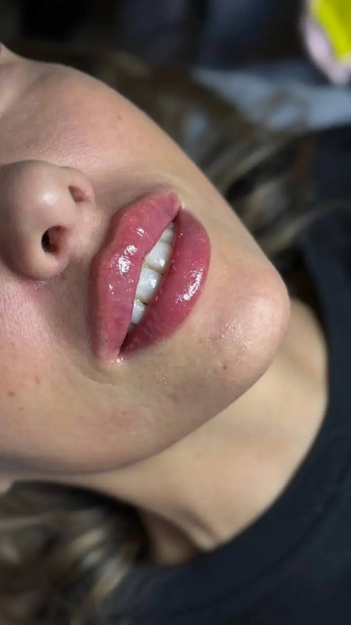 Контурная пластика губ - Косметология (Услуги) в Красноярск