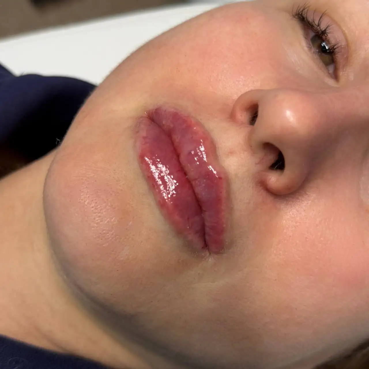 Контурная пластика губ - Косметология (Услуги) в Красноярск