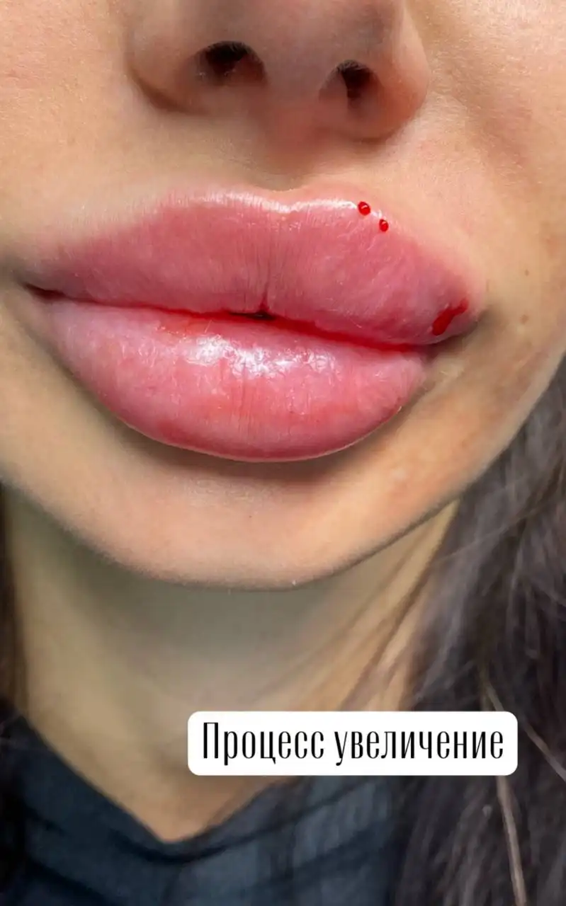 Контурная пластика губ - Косметология (Красота и здоровье) в Красноярск