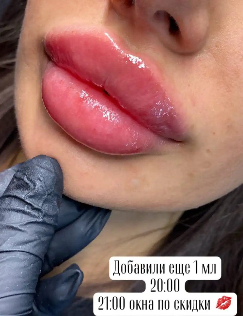 Контурная пластика губ - Косметология (Красота и здоровье) в Красноярск