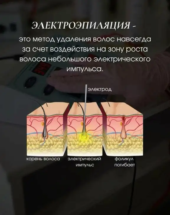 Услуги электроэпиляции и депиляции в г. Новоаннинский - Красота и здоровье (Услуги) в Новоаннинский