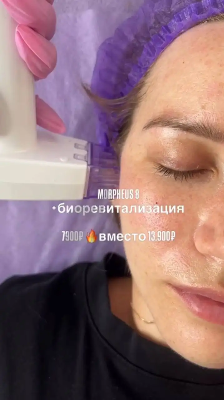 Микроигольчатый РФ-лифтинг - Косметология (Красота и здоровье) в Екатеринбург