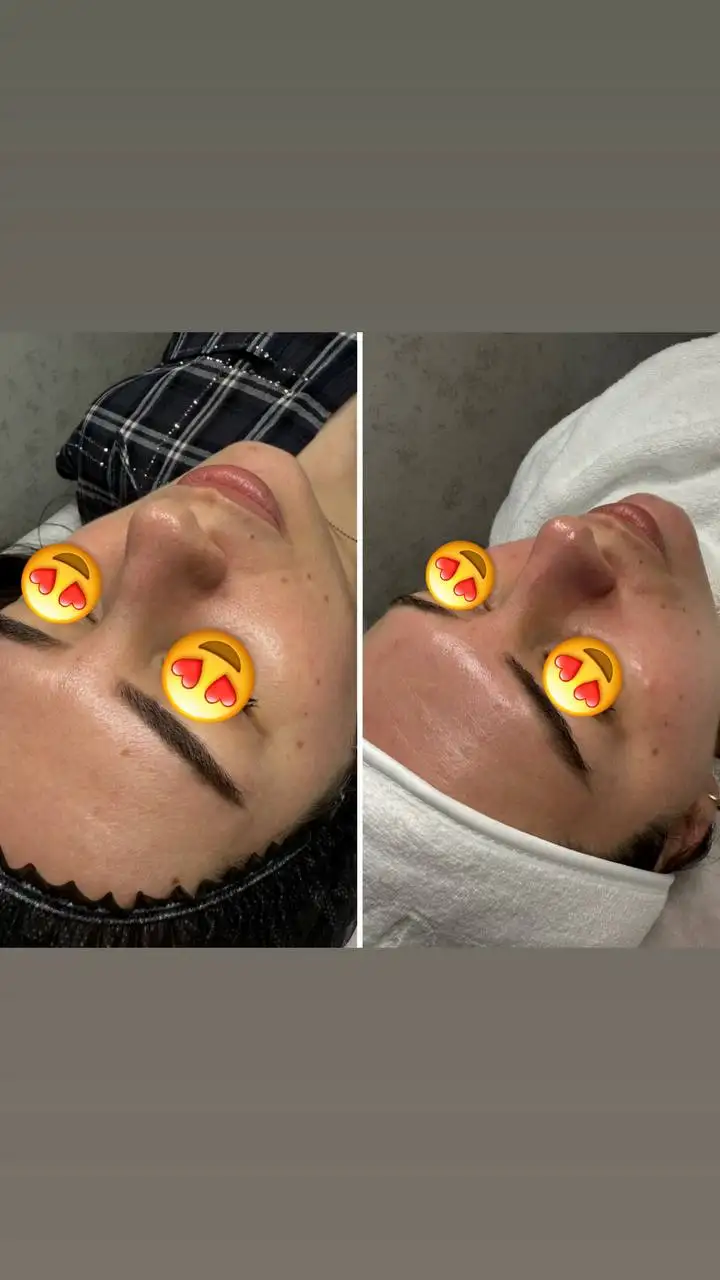 Комбинированная чистка лица с пилингом BioRePeel - Косметология (Услуги) в Ставрополь