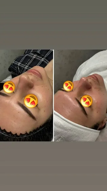 Комбинированная чистка лица с пилингом BioRePeel - Услуги в Ставрополь