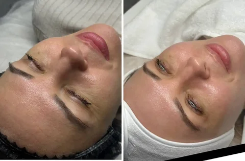 Чистка лица и пилинг в Ставрополе - Красота и здоровье в Ставрополь