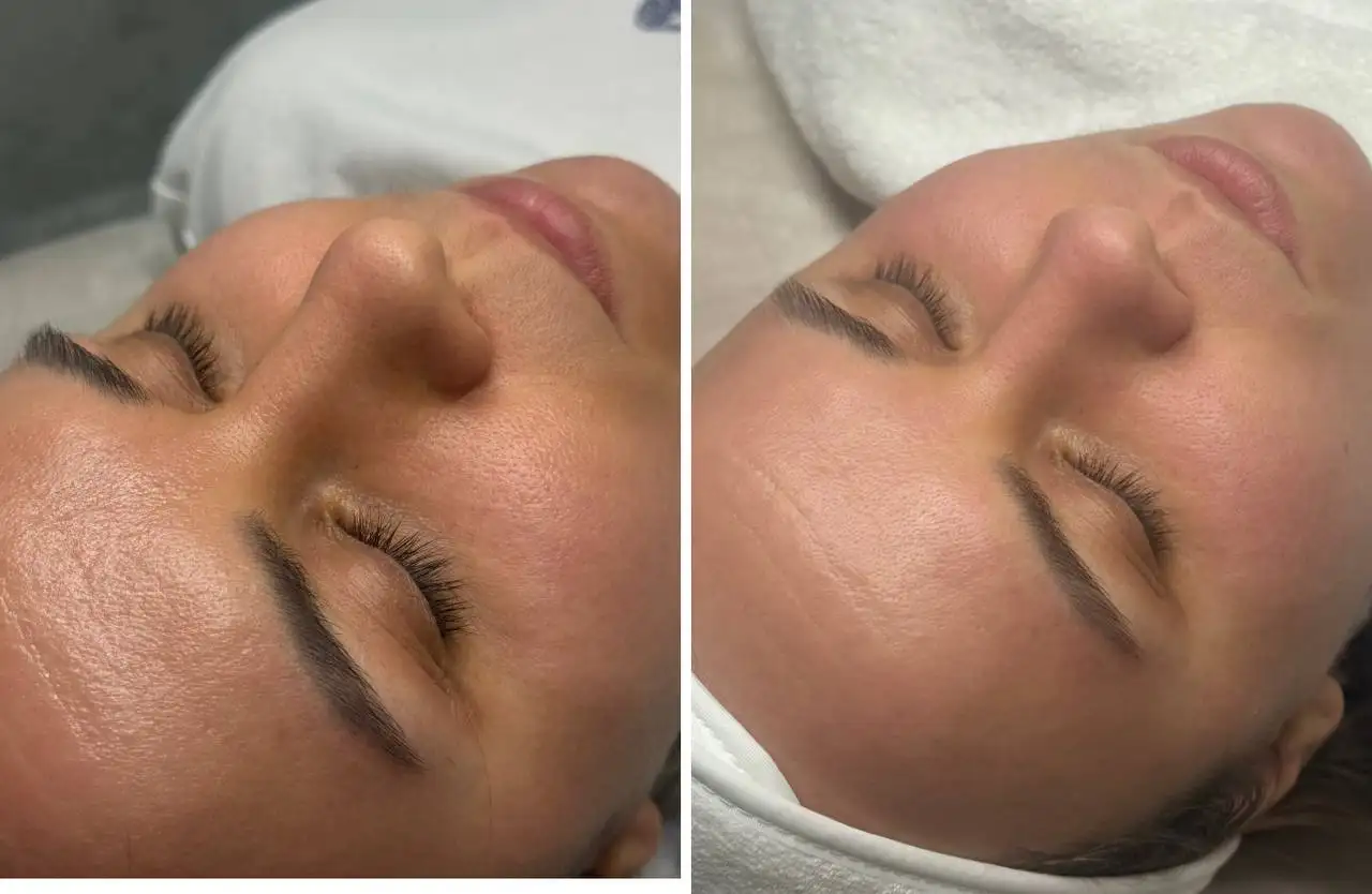 Чистка и пилинг кожи - Красота и здоровье в Ставрополь