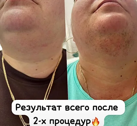 Лазерная эпиляция на новейшем аппарате - Политические услуги в Ставрополь