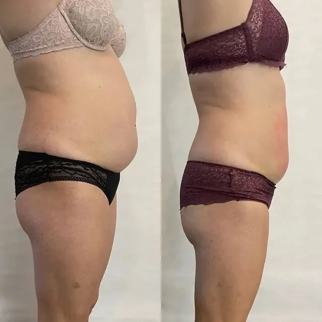 Коррекция фигуры аппаратным массажем - Шиномонтаж в Чебоксары