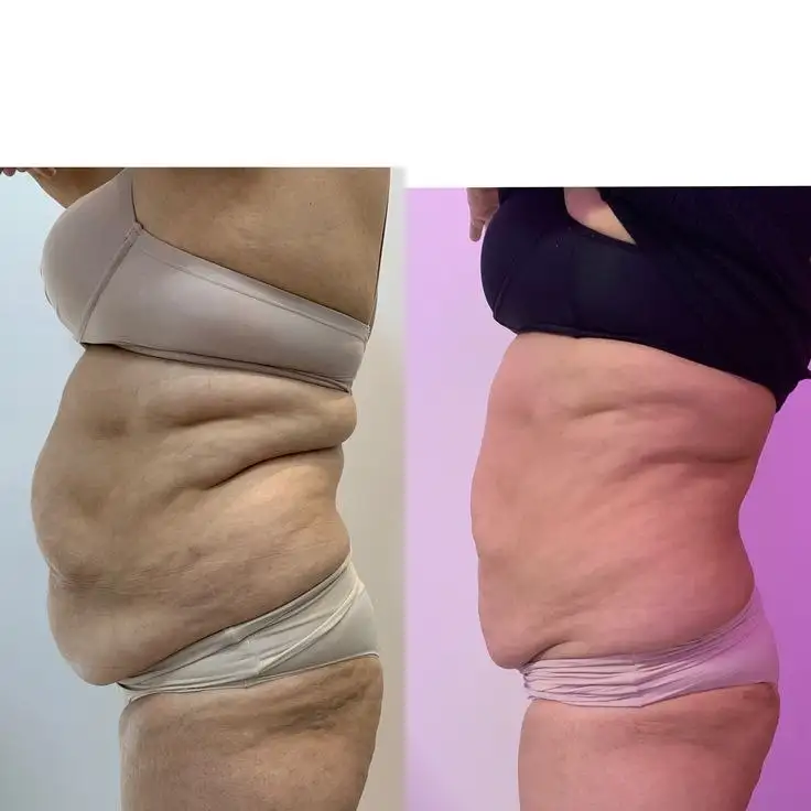 Коррекция фигуры аппаратным массажем - Красота и здоровье (Услуги) в Чебоксары