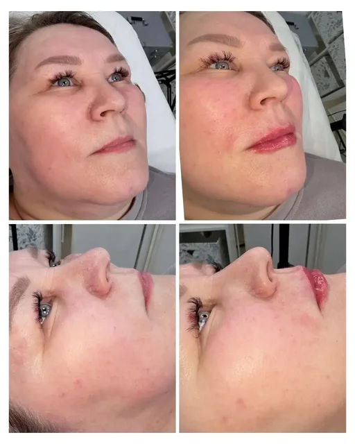 Аппаратное увеличение губ - Гараж в Чебоксары