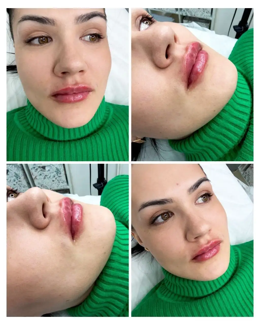 Аппаратное увеличение губ - Косметология (Услуги) в Чебоксары