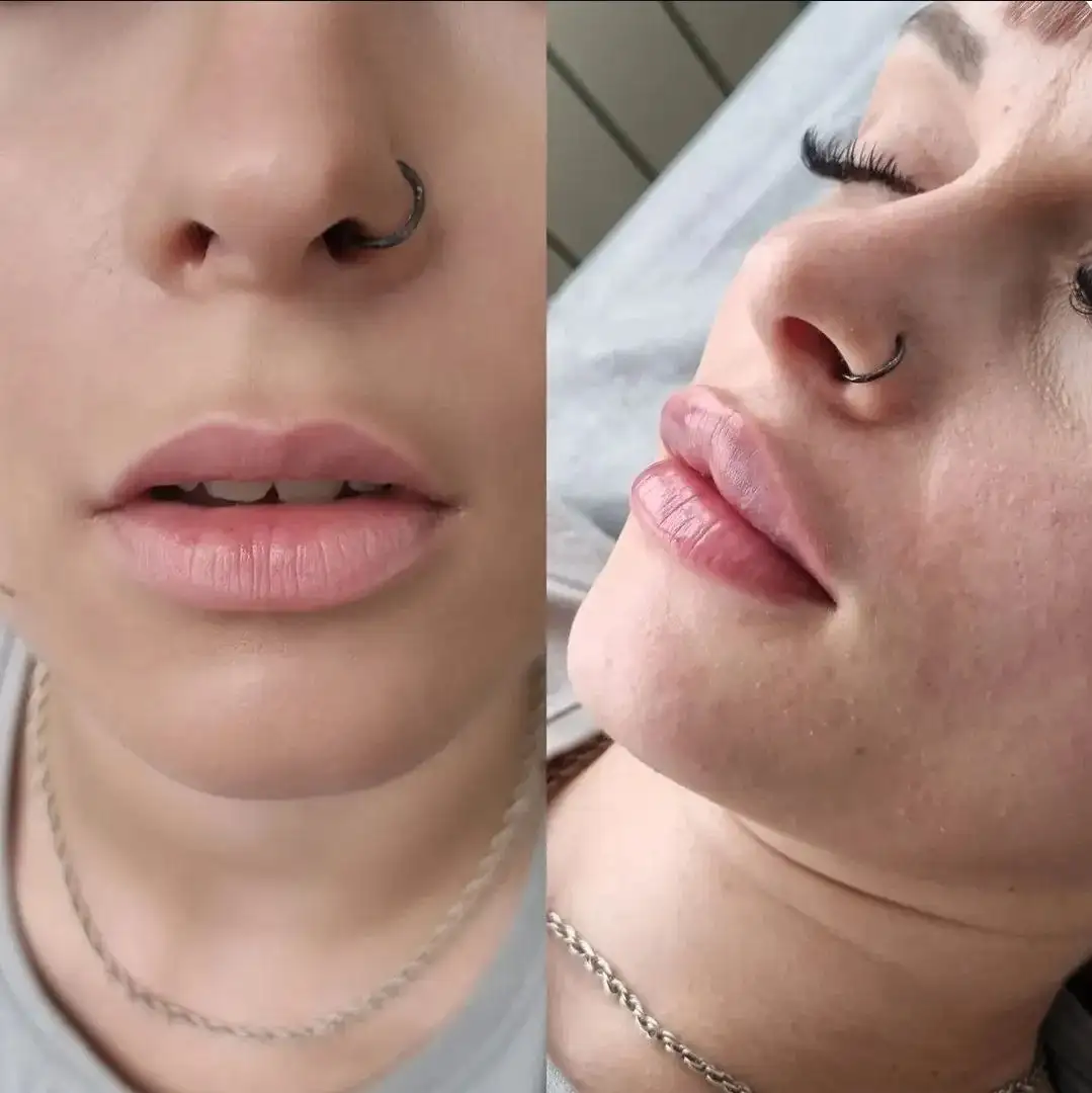 Контурная пластика губ во Владивостоке - Красота и здоровье (Услуги) в Владивосток