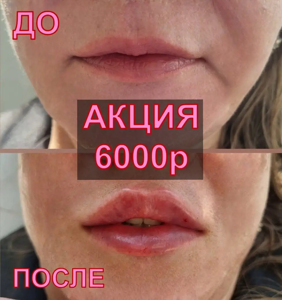 Контурная пластика губ и увеличение - Красота и здоровье (Услуги) в Владивосток