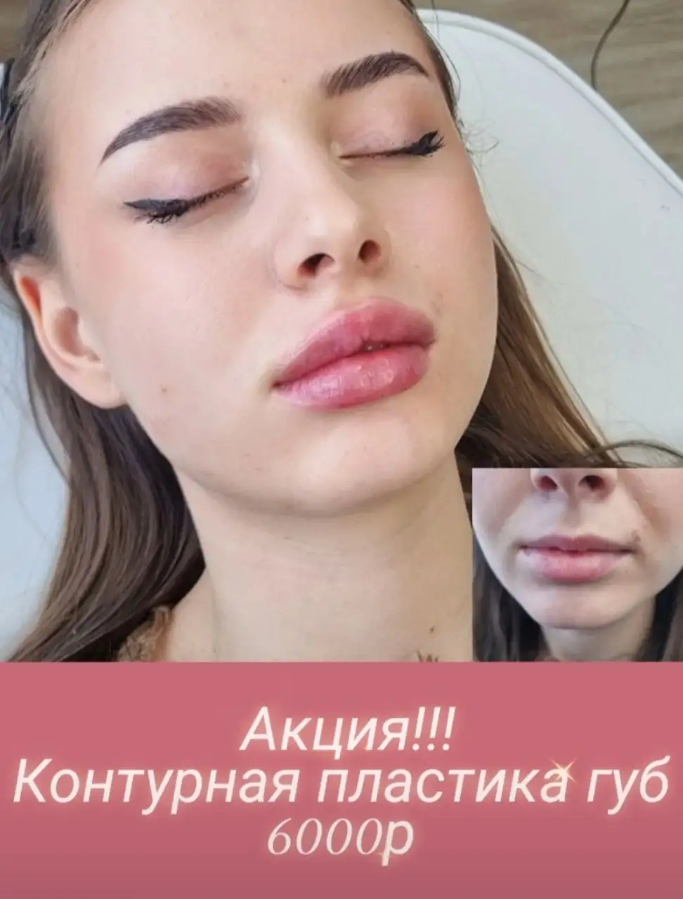 Контурная пластика губ - Косметические процедуры (Красота и здоровье) в Владивосток