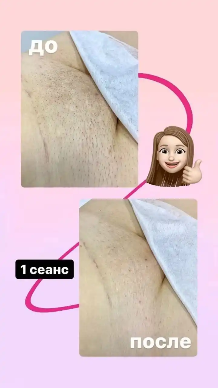 Лазерная эпиляция по приятным ценам - Красота и здоровье в Симферополь