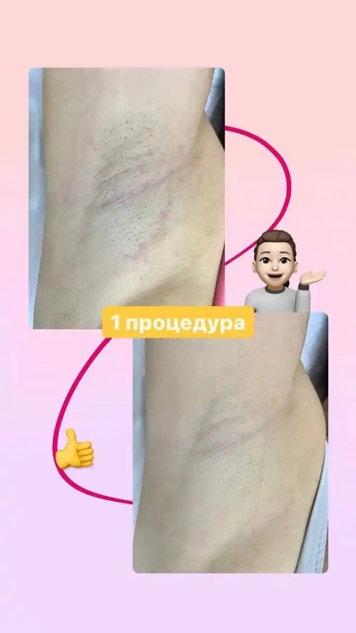 Лазерная эпиляция по приятным ценам