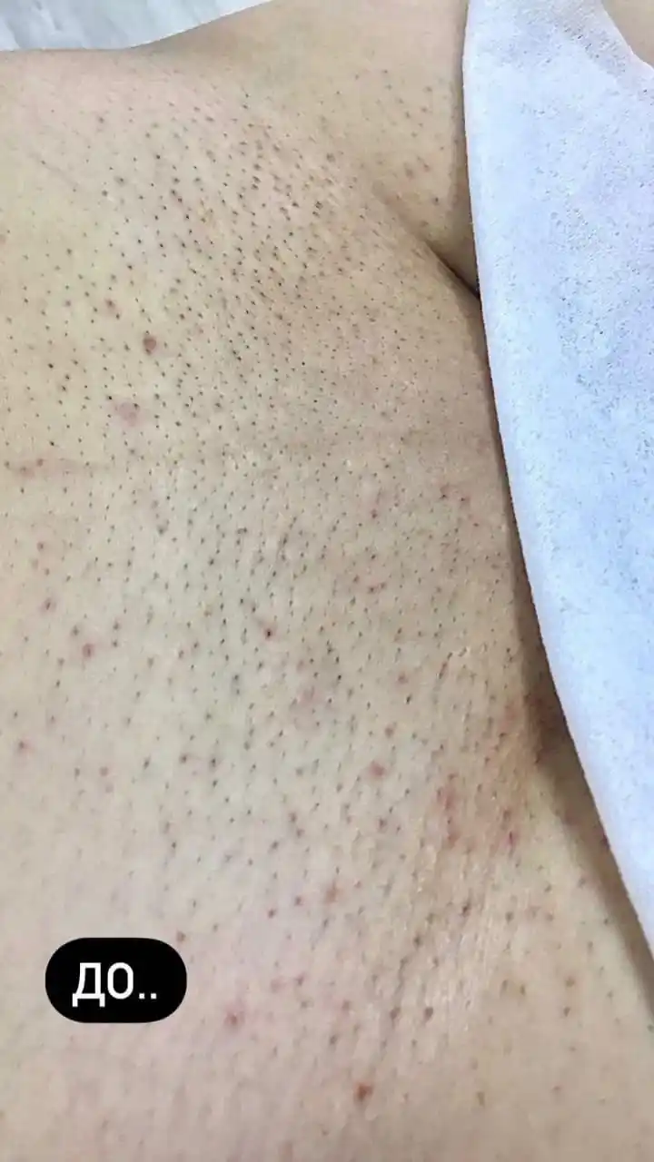 Лазерная эпиляция по приятным ценам