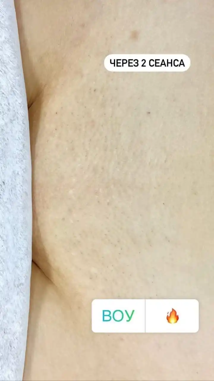 Лазерная эпиляция по приятным ценам