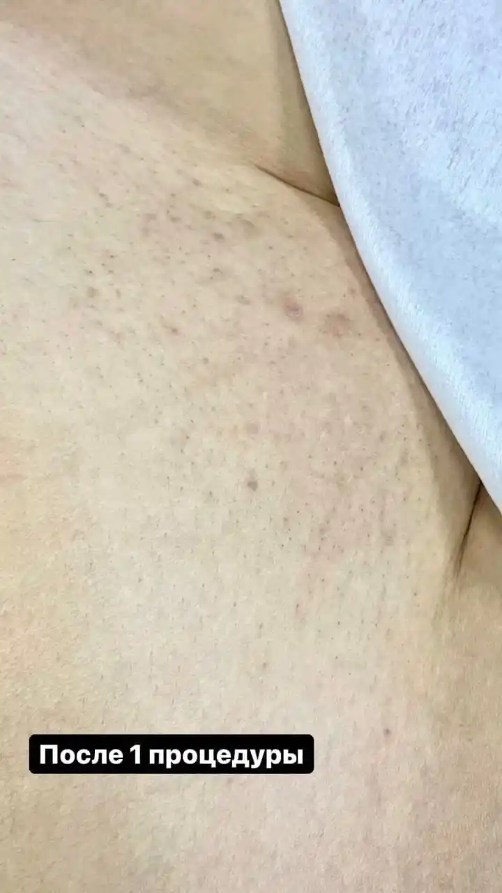 Лазерная эпиляция по приятным ценам