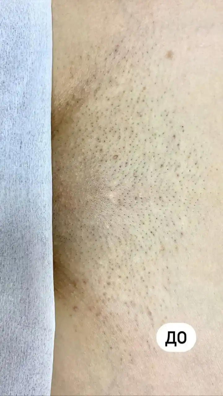 Лазерная эпиляция по приятным ценам