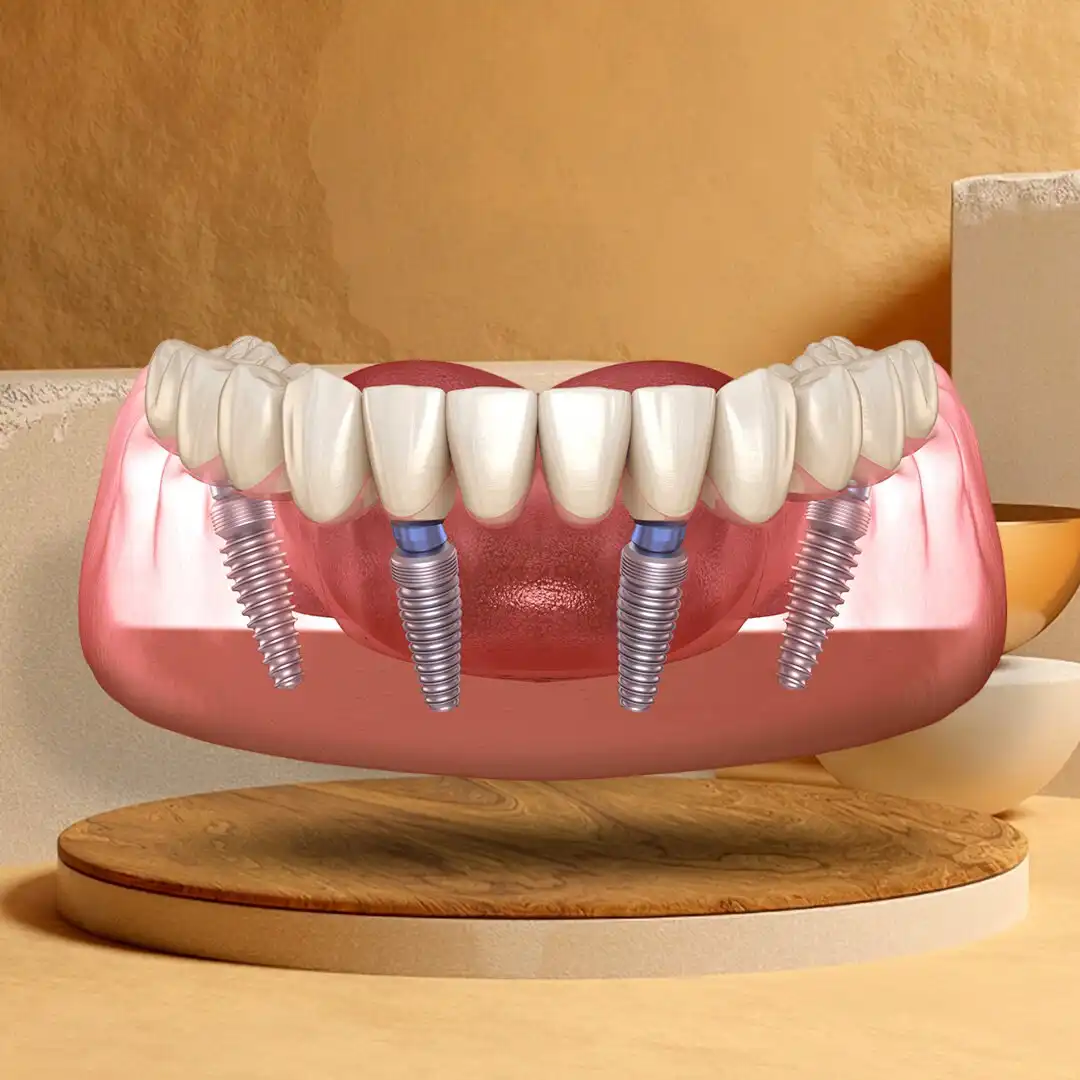 Восстановление всех зубов на 4 импланта в Самаре - Медицинские услуги (Услуги) в Самара