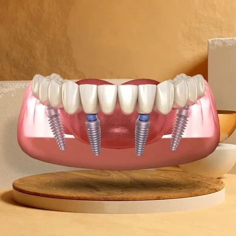 Восстановление всех зубов на 4 имплантах в Самаре - Дезинфекция в Самара