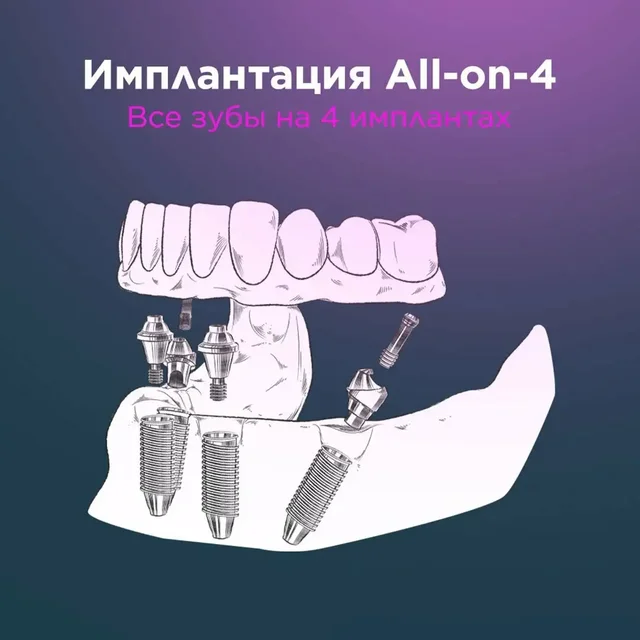 Восстановление челюсти по швейцарскому методу в Самаре - 3D-печать в Самара