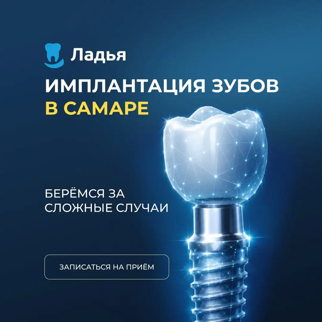 Имплантация зубов за 1 день в Самаре. Приём бесплатно! - Стоматология (Красота и здоровье) в Самара