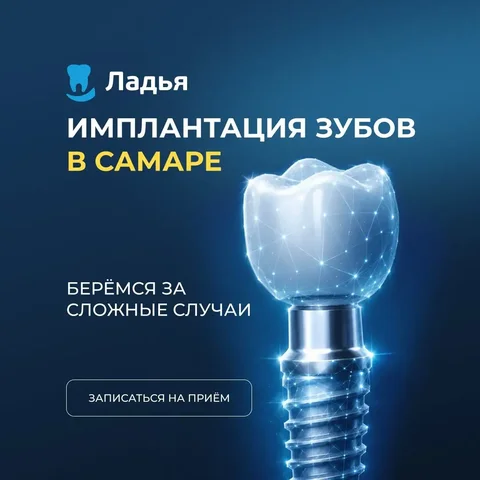 Имплантация зубов за 1 день в Самаре. Приём бесплатно! - частное объявление в Самара