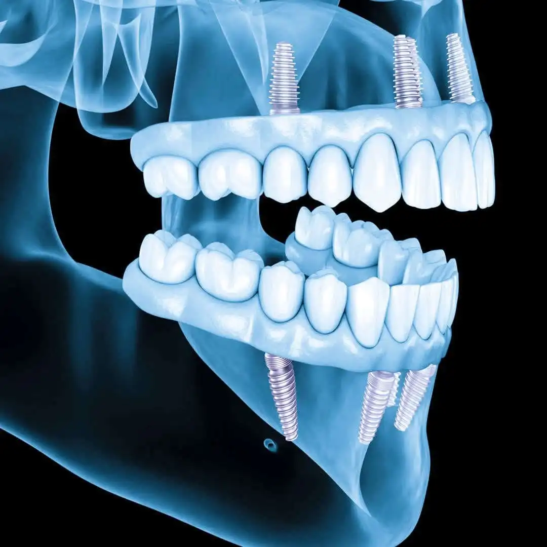 Имплантация зубов на 4 имплантах