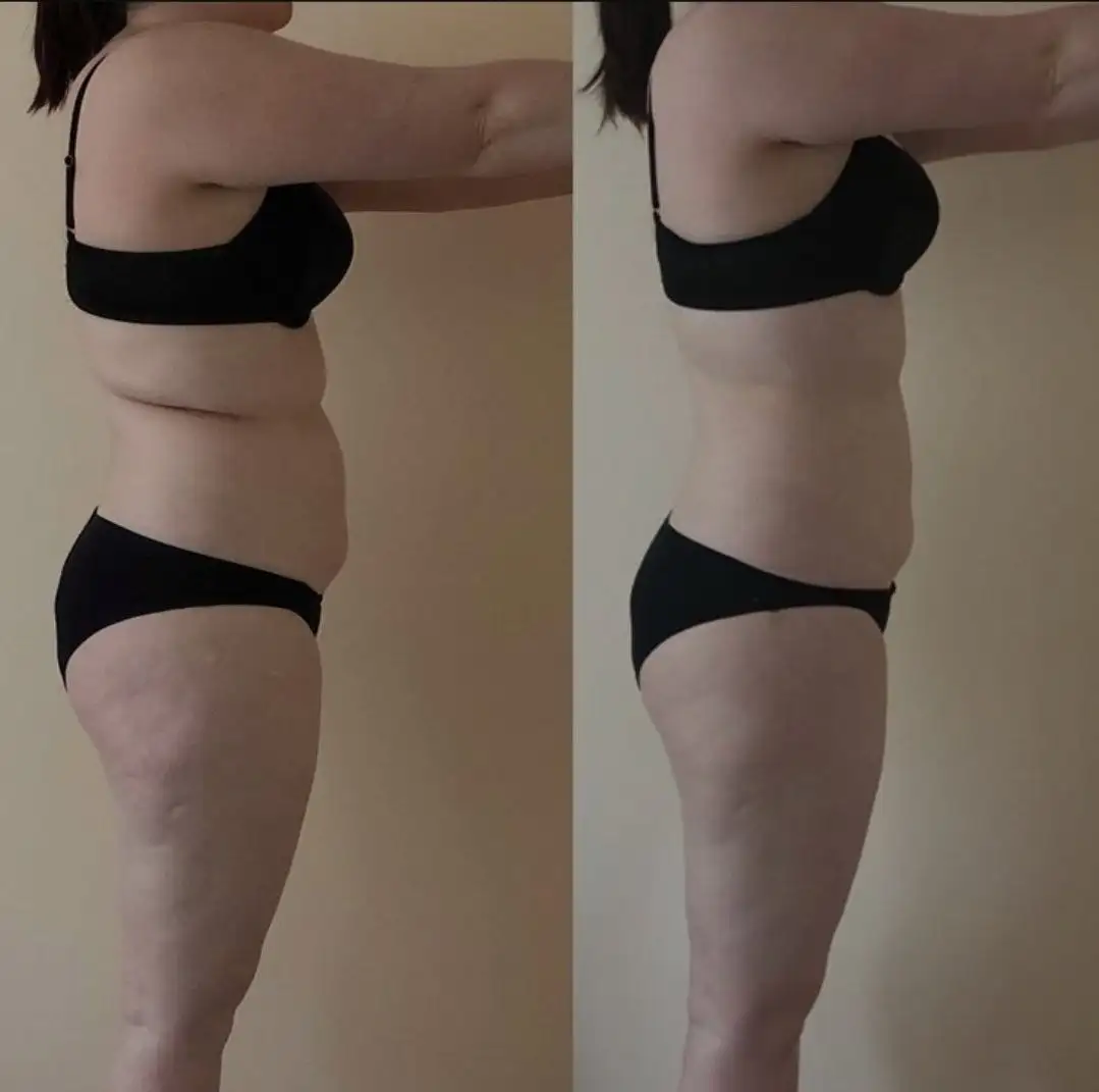 Вакуумно-роликовый массаж для подготовки к лету - Косметологические услуги (Услуги) в Барнаул