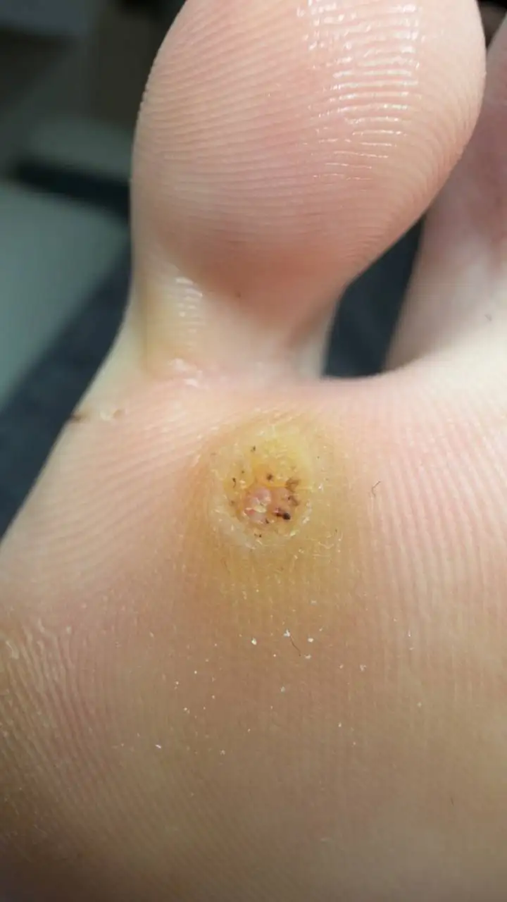 Удаление бородавок - Медицинские услуги (Услуги) в Оренбург