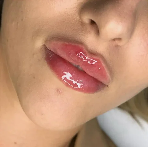 Контурная пластика губ с использованием качественных филлеров - Красота и здоровье в Краснодар